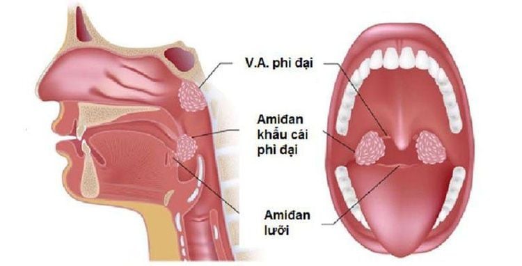 đau Cuống Lưỡi